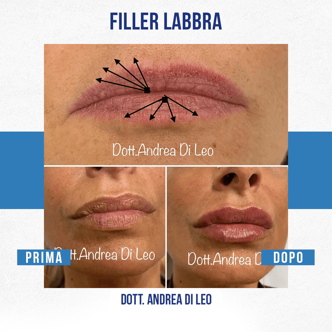 img-Filler-Labbra-DiLeo-2