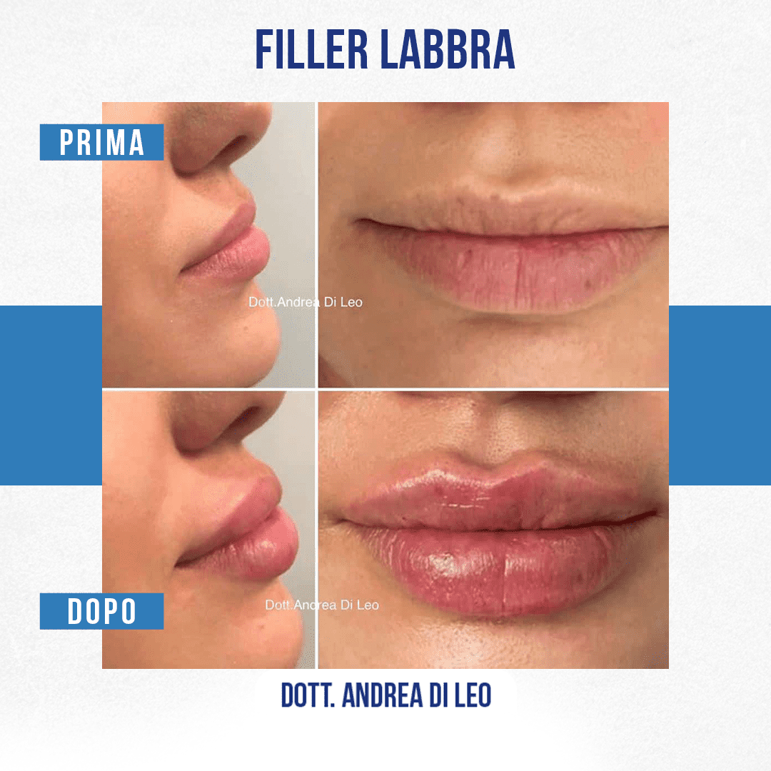 img-Filler-Labbra-DiLeo-4