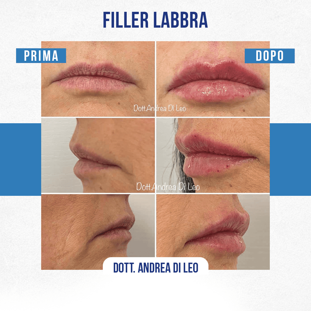 img-Filler-Labbra-DiLeo-5