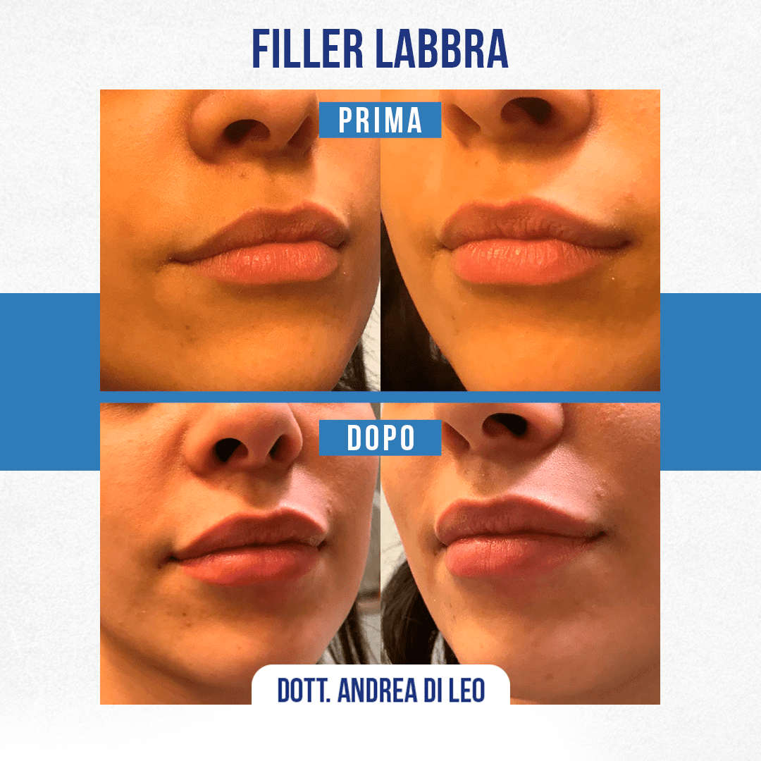 img-Filler-Labbra-DiLeo-6