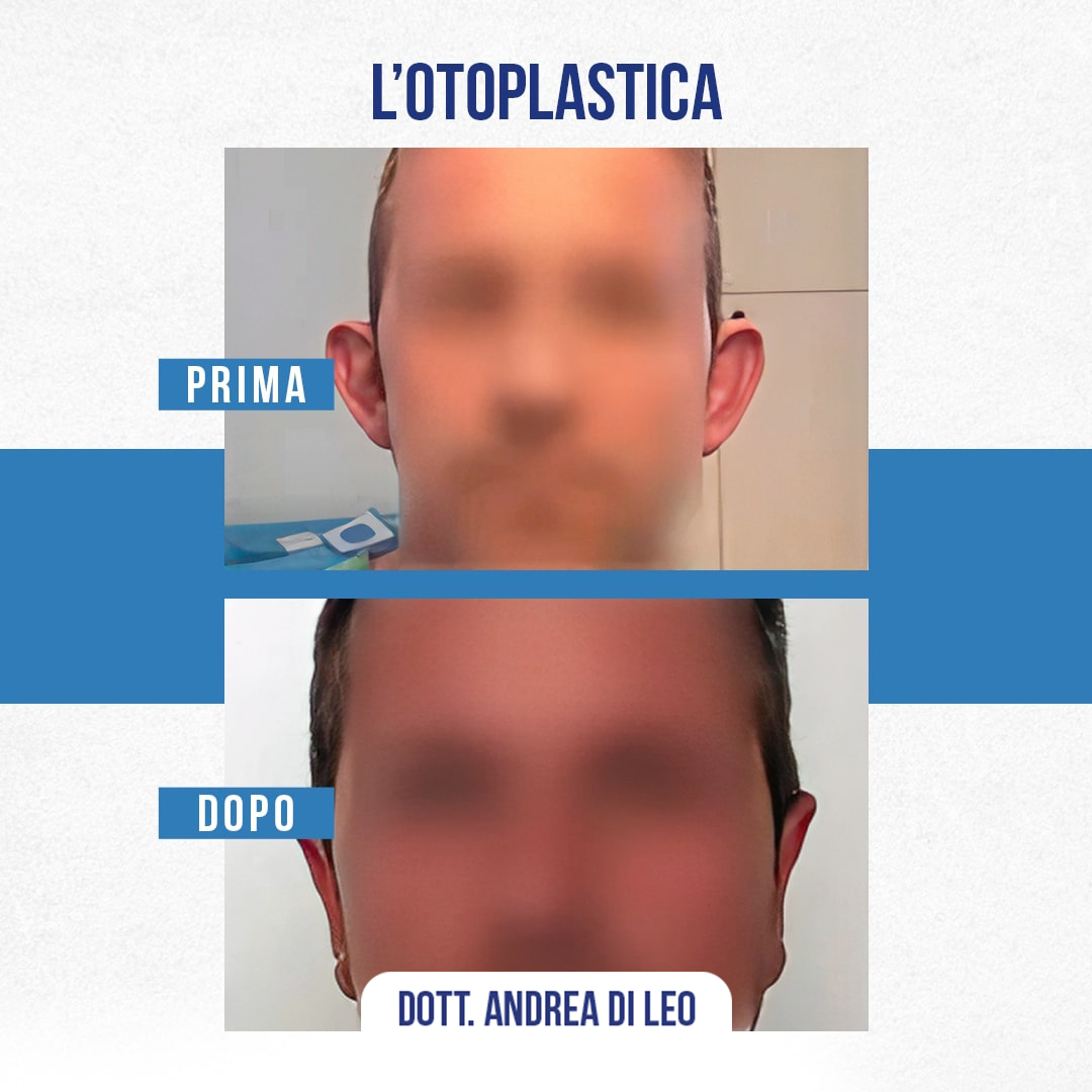 img-Prima-Dopo-OTOPLASTICA-01