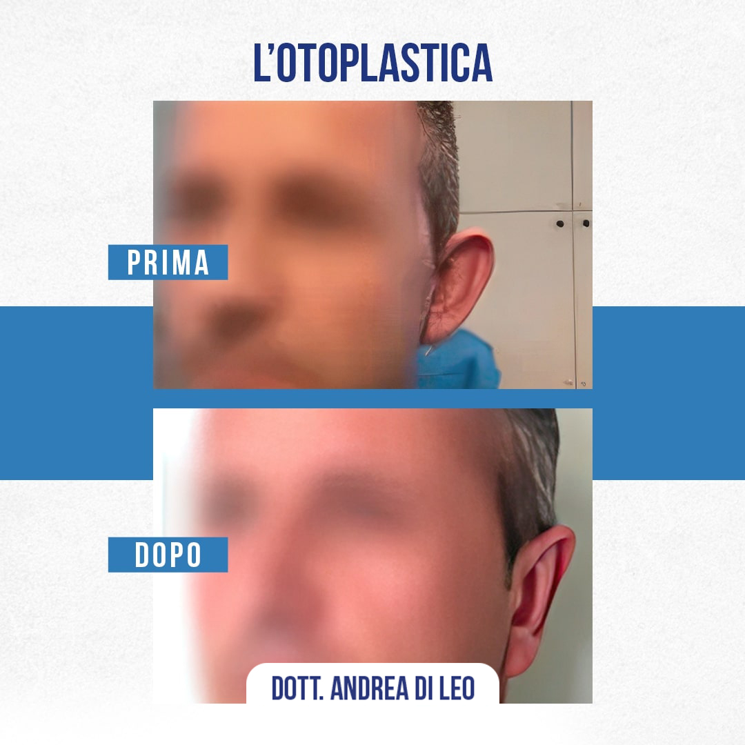 img-Prima-Dopo-OTOPLASTICA-02