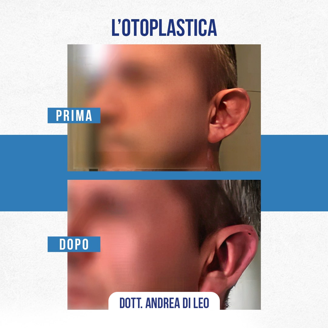 img-Prima-Dopo-OTOPLASTICA-03