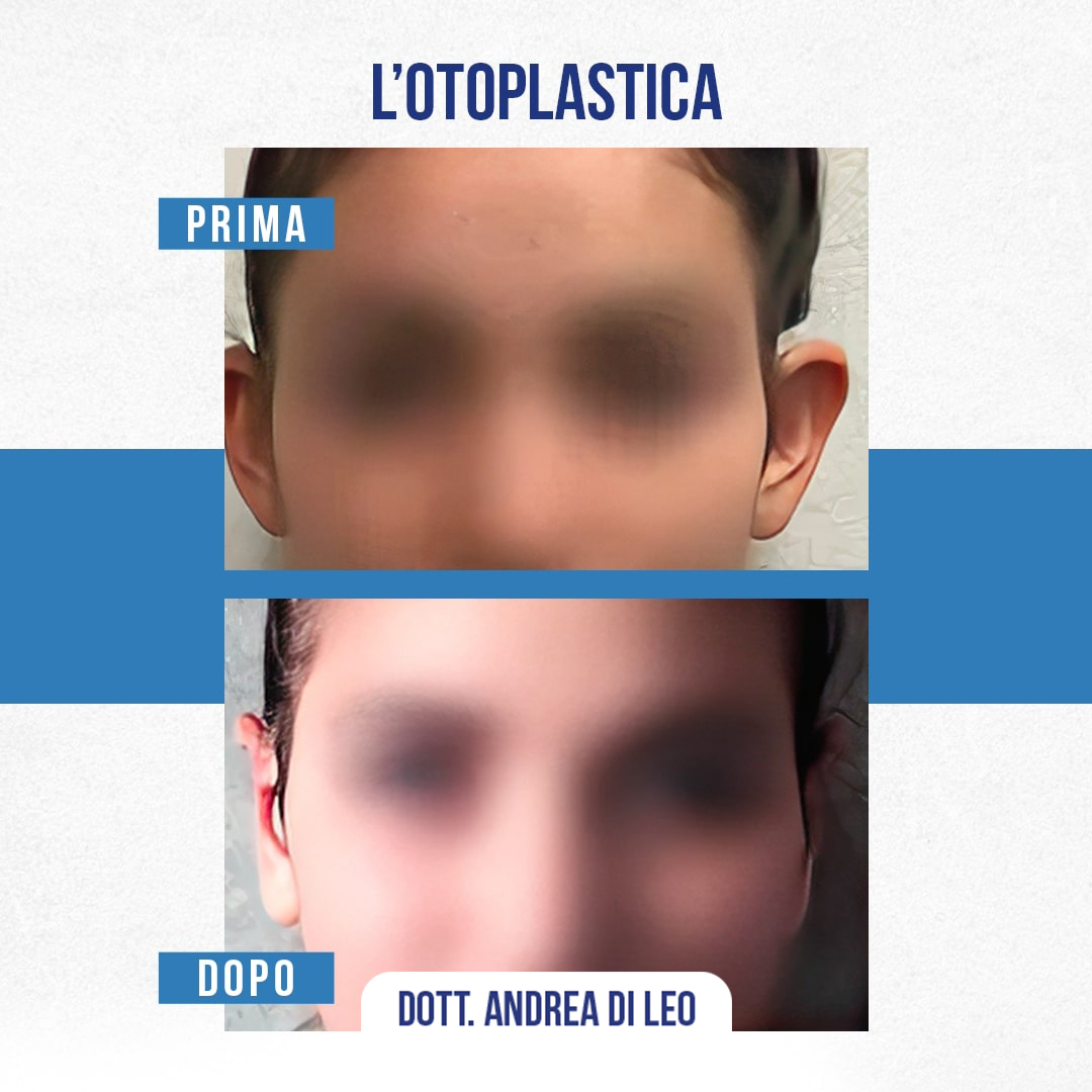 img-Prima-Dopo-OTOPLASTICA-04