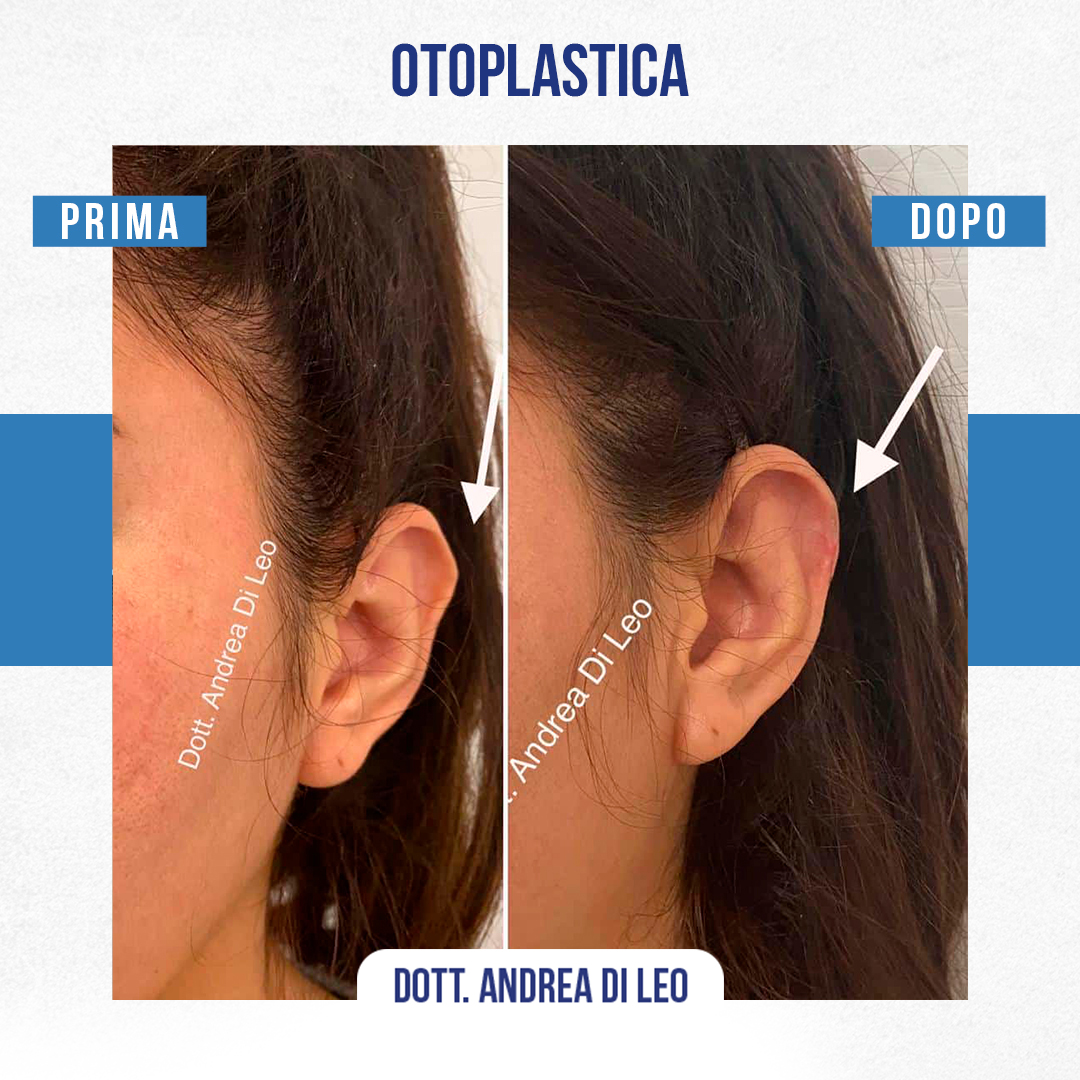 img-Prima-Dopo-OTOPLASTICA-10