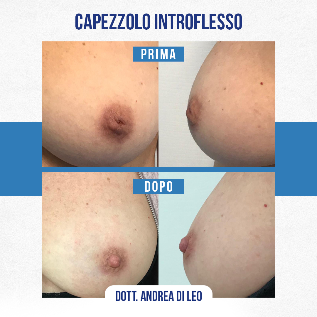 img-prim-dop-Capezzolo-Introflesso-1