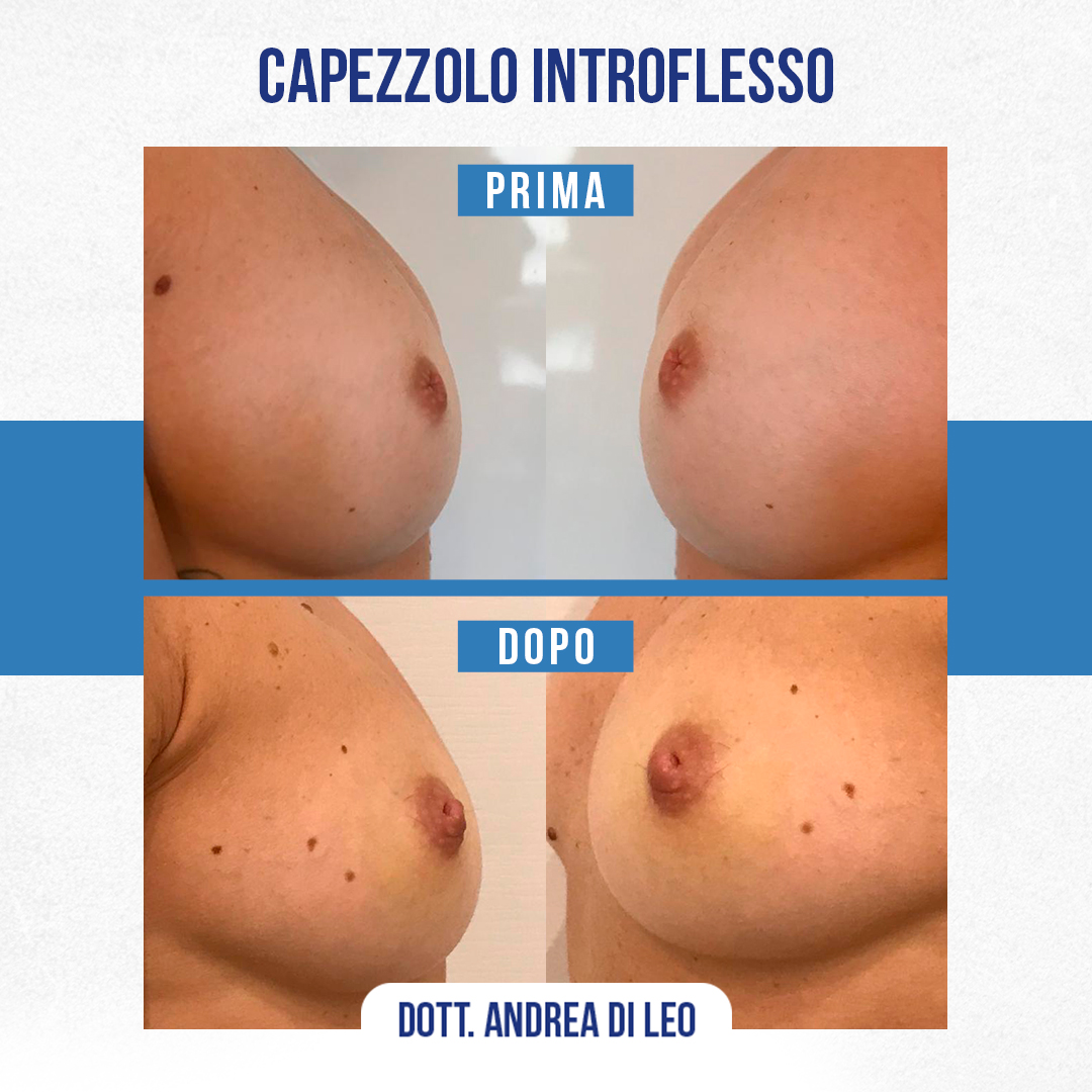 img-prim-dop-Capezzolo-Introflesso-3