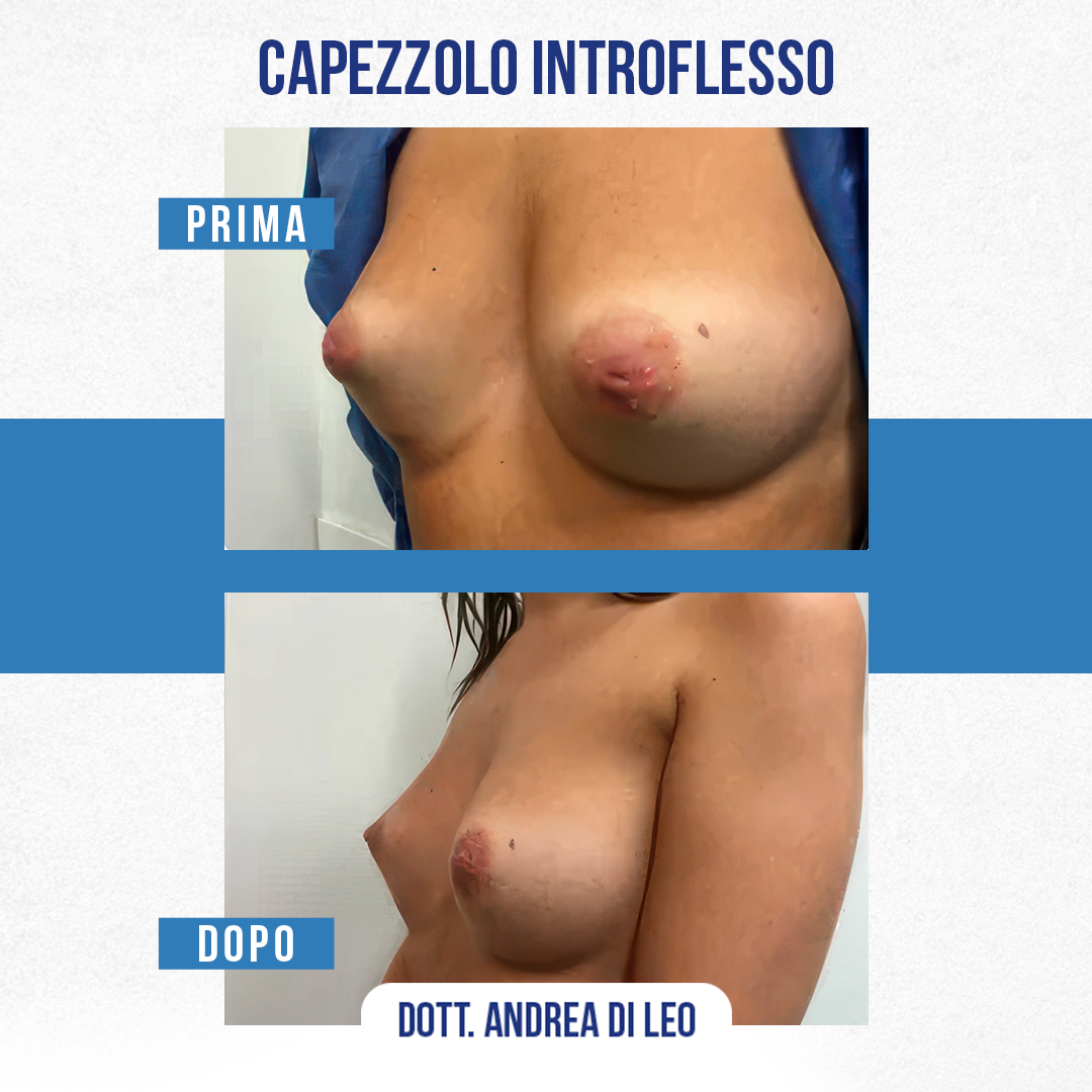 img-prim-dop-Capezzolo-Introflesso-6