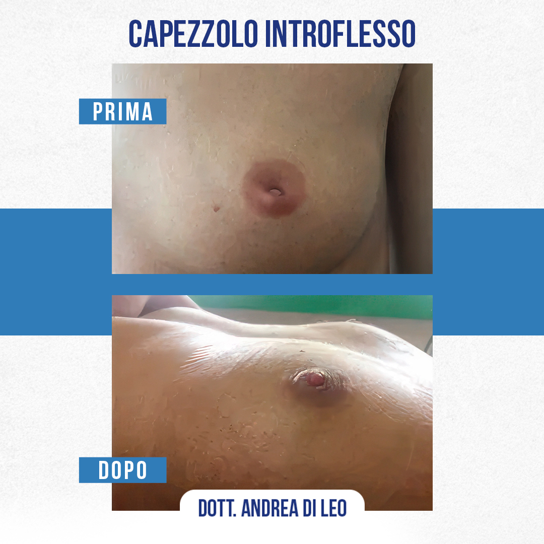 img-prim-dop-Capezzolo-Introflesso-7