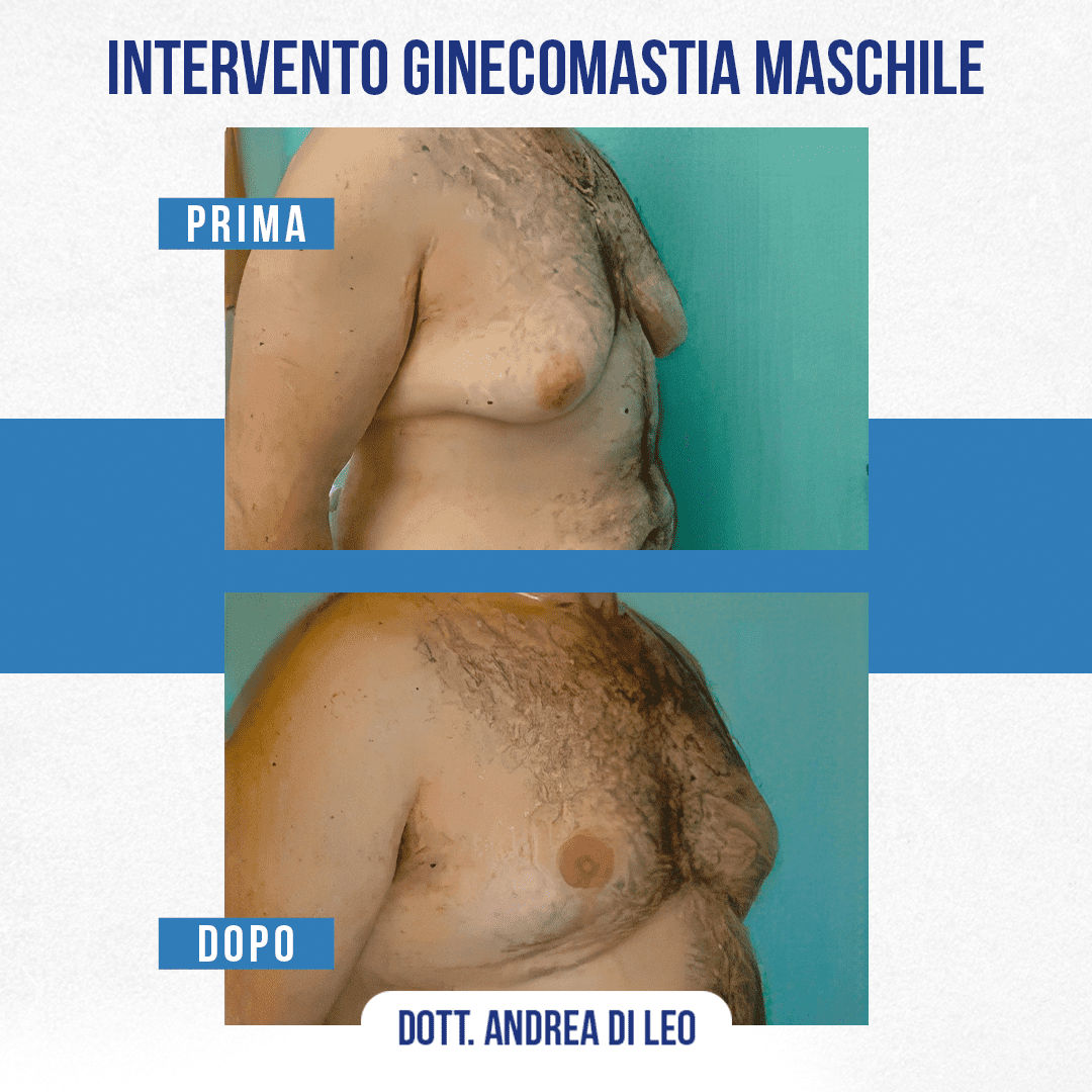 img-prim-dop-INTERVENTO GINECOMASTIA MASCHILE-1