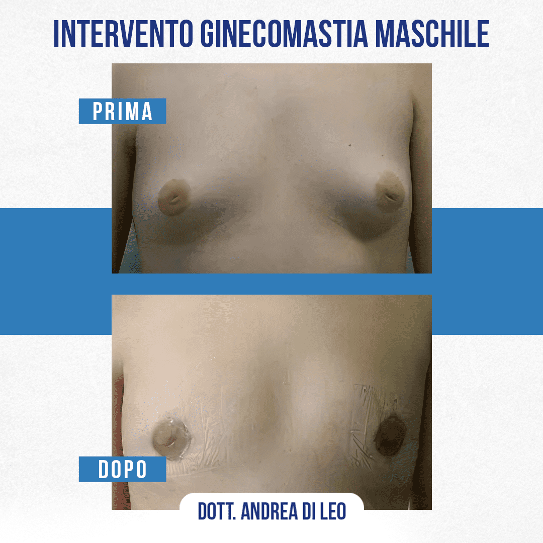 img-prim-dop-INTERVENTO GINECOMASTIA MASCHILE-3