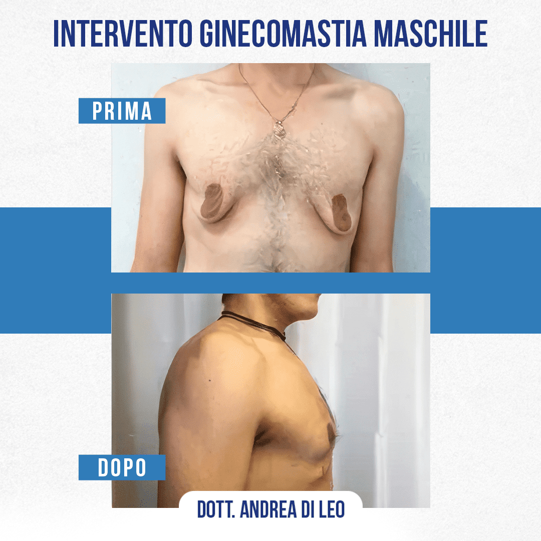 img-prim-dop-INTERVENTO GINECOMASTIA MASCHILE-4