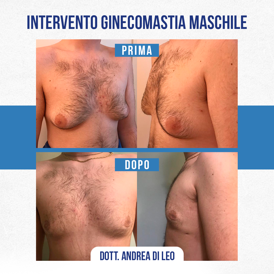 img-prim-dop-INTERVENTO GINECOMASTIA MASCHILE-5