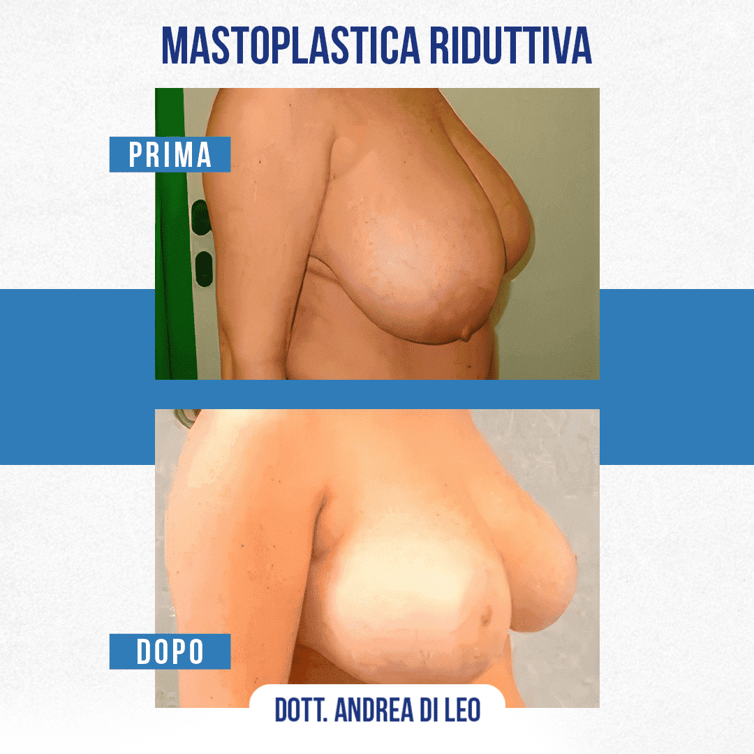 img-prim-dop-MASTOPLASTICA RIDUTTIVA-3