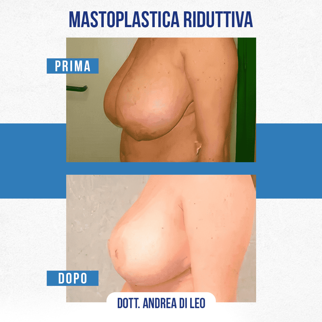 img-prim-dop-MASTOPLASTICA RIDUTTIVA-5