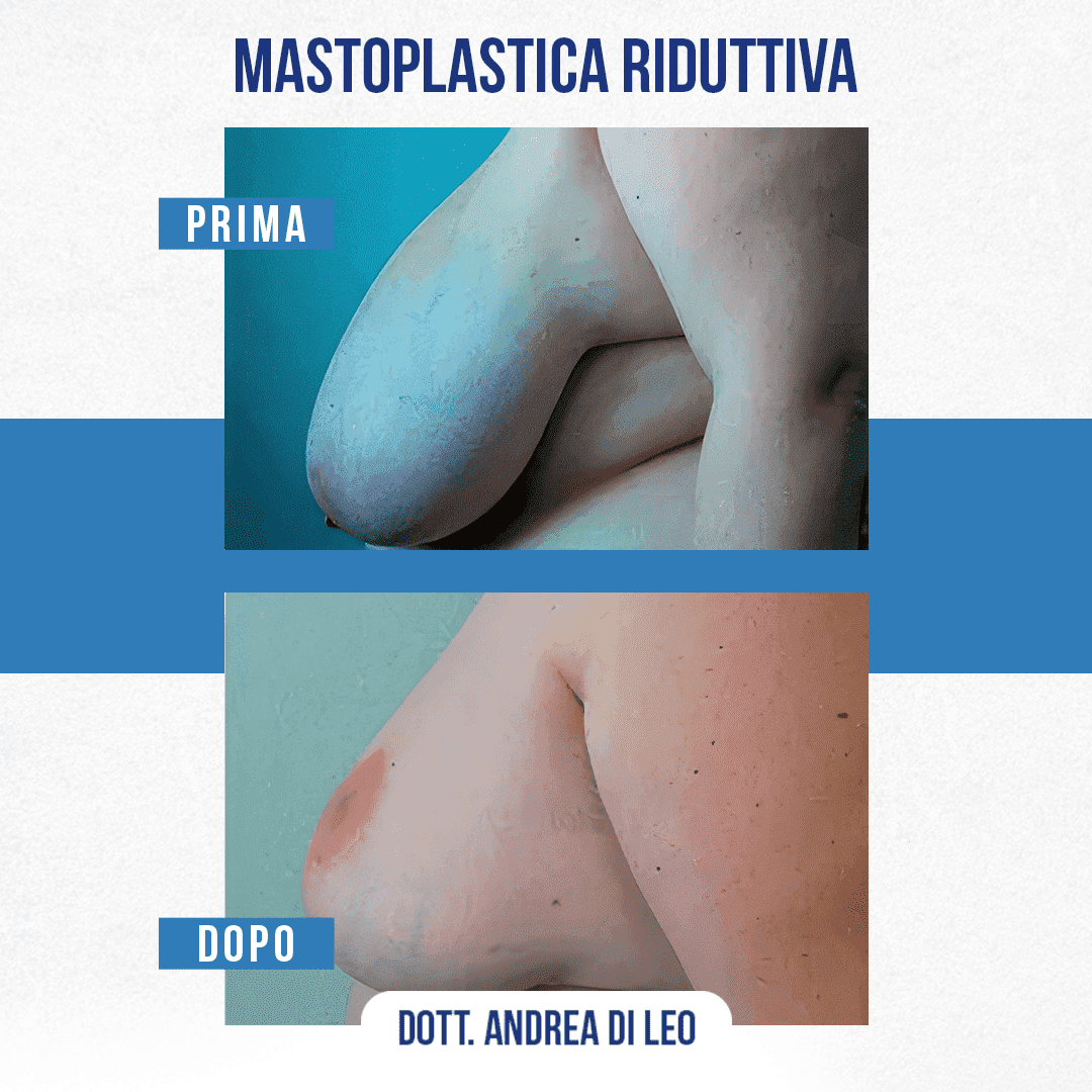 img-prim-dop-MASTOPLASTICA RIDUTTIVA-8